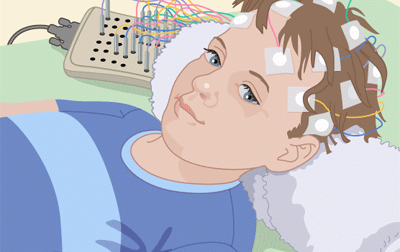 VEEG (Video-Electroencephalography)